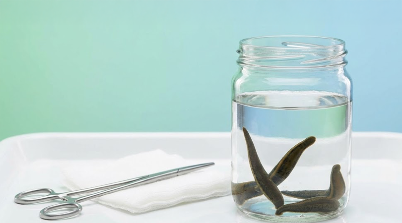 Tıbbi Sülük Tedavisi (Hirudoterapi)